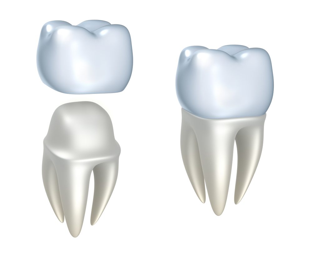 dental crowns