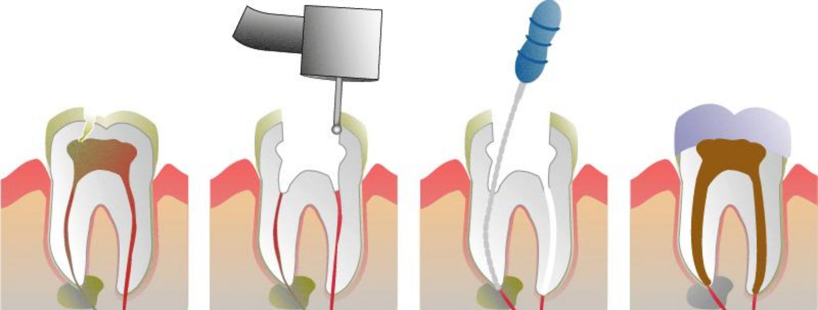root canal dentist
