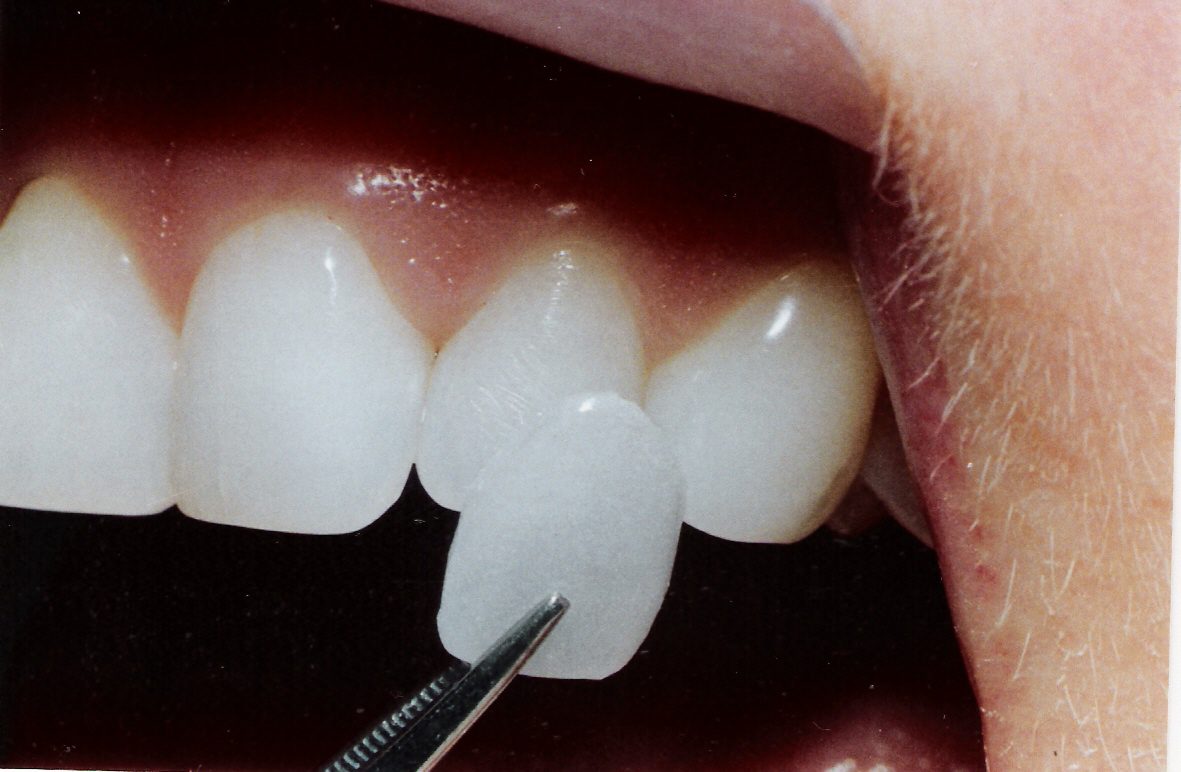 dental veneers