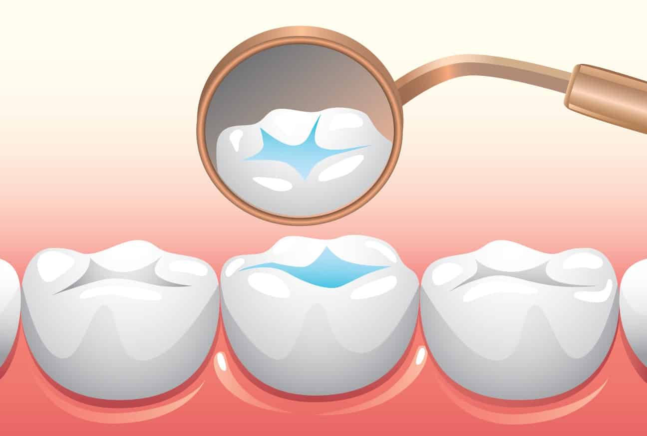 Dental Sealants Teeth Sealants Tooth Sealant Visalia CA