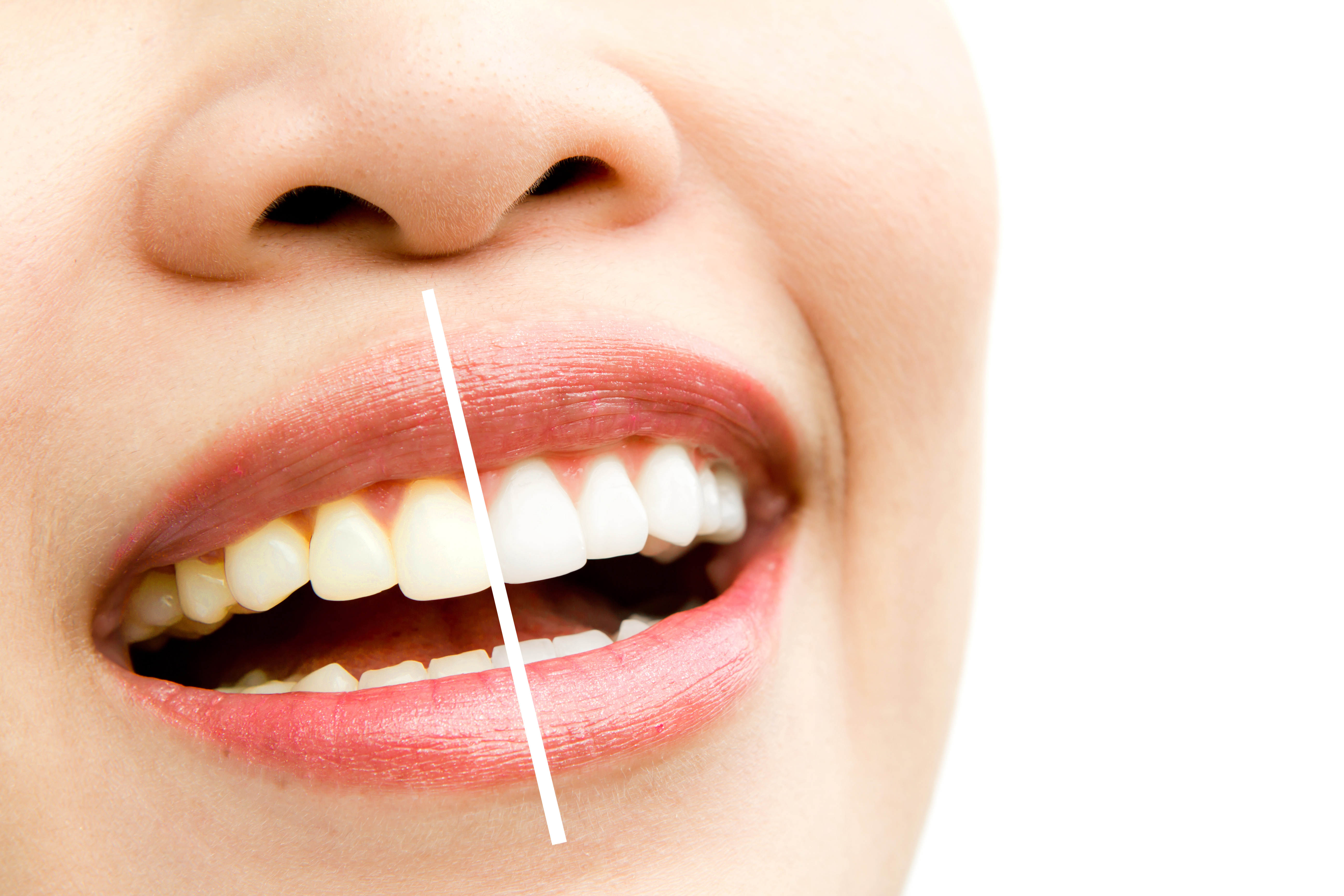 teeth whitening dentist