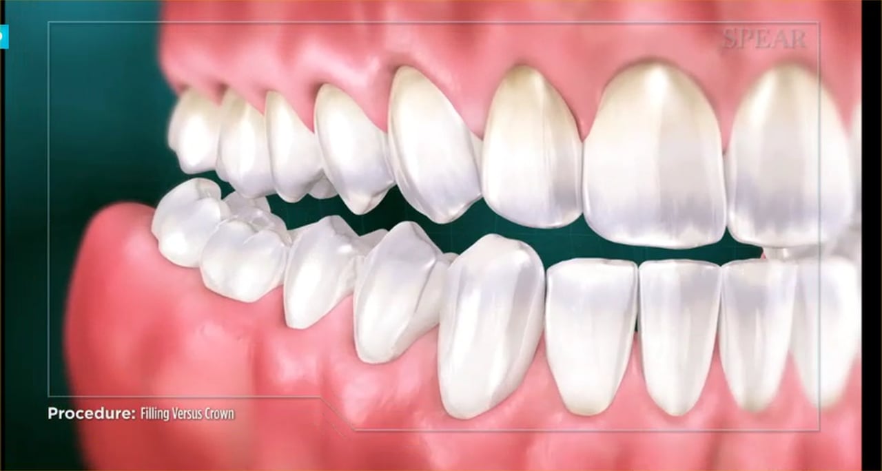 What Is the Difference Between a Crown and A Filling? Visalia Dentist