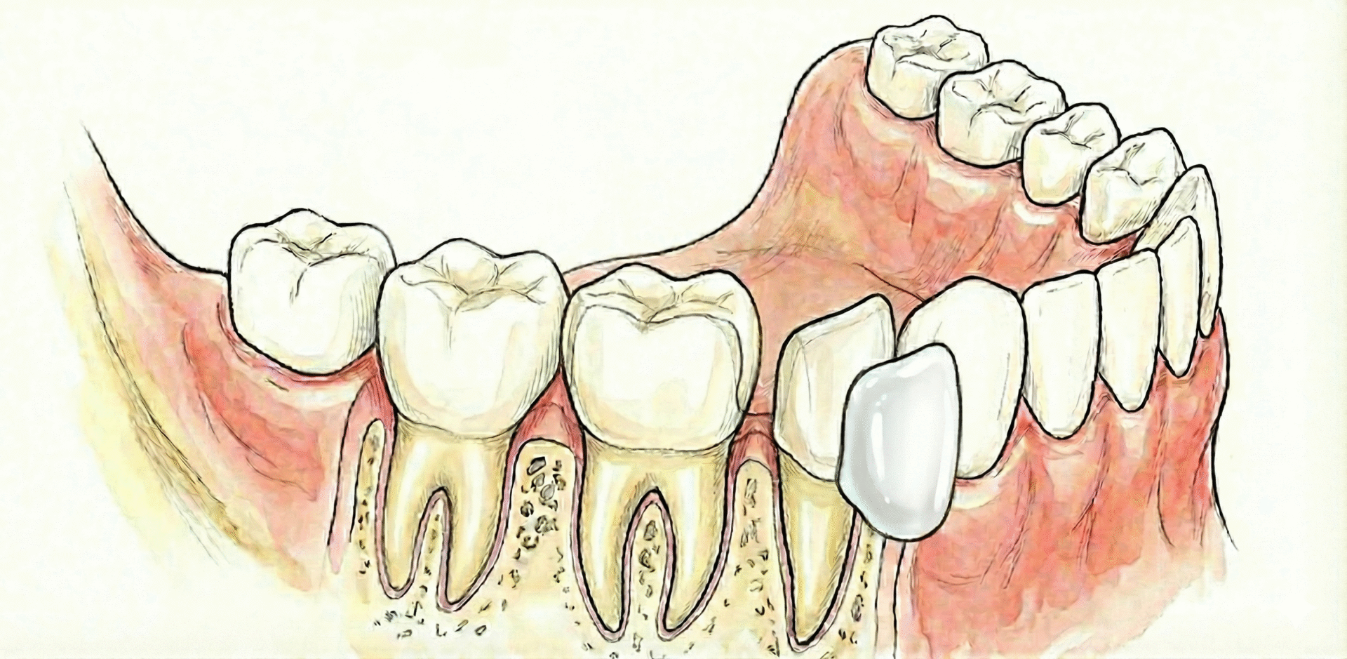 AI visualization created Porcelain  Veneer using Canva and Gemini