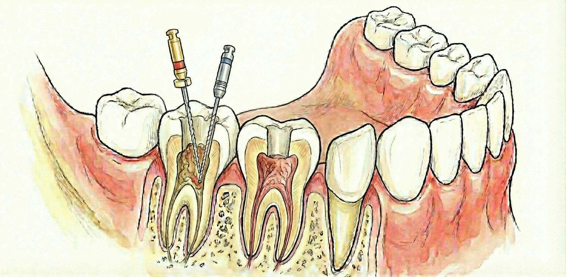 AI visualization created Root Canal using Canva and Gemini