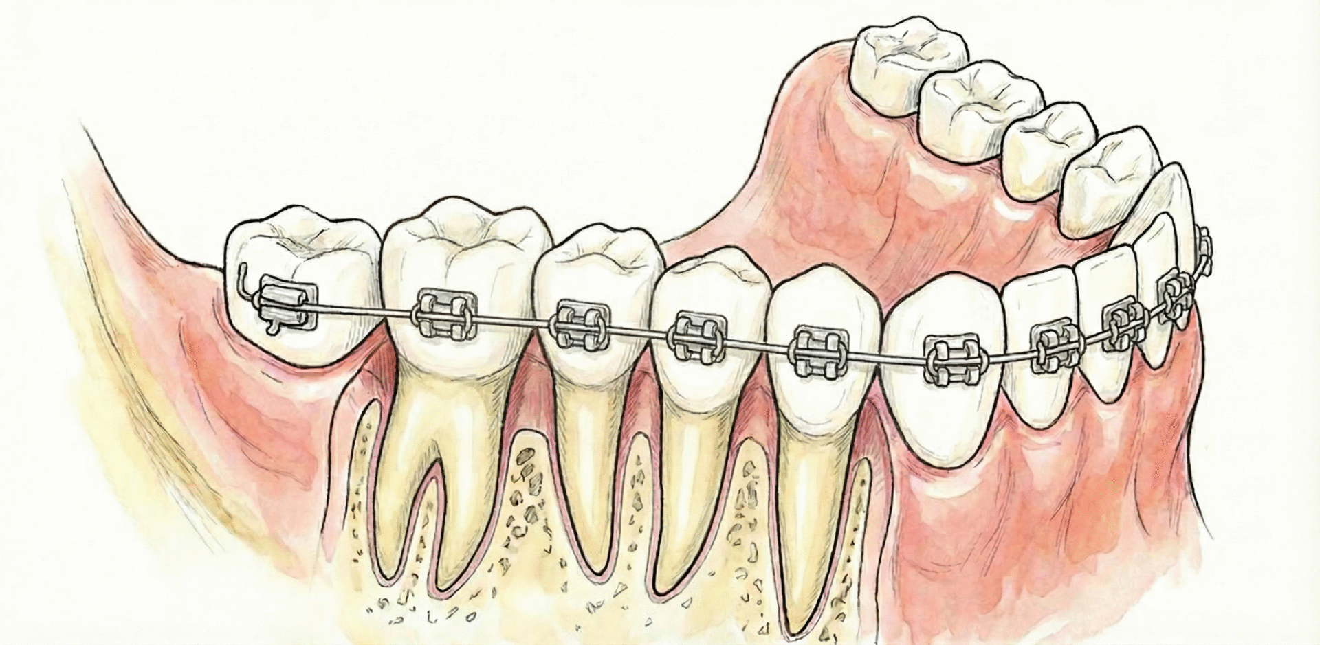 AI visualization created Braces using Canva and Gemini