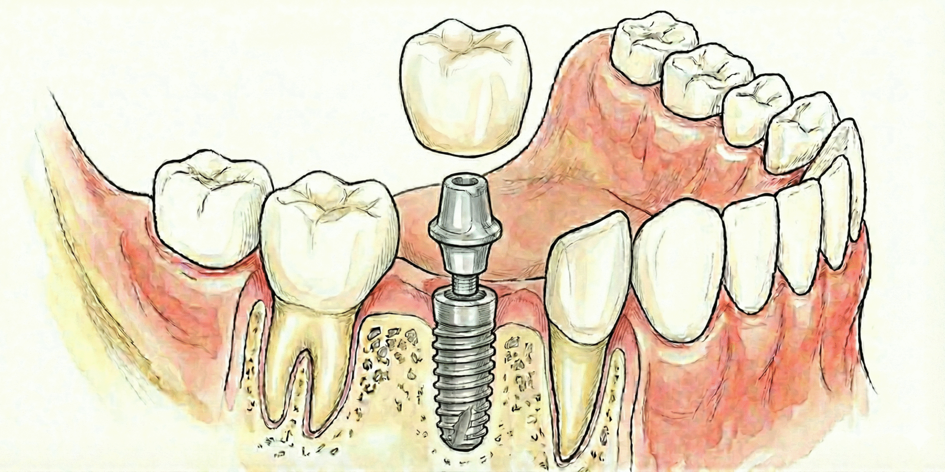 AI visualization created Dental Implant using Canva and Gemini