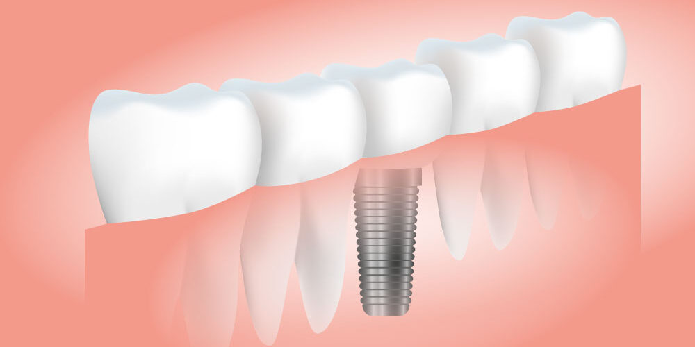 dental implants visalia ca